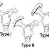 acromion-types