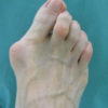 Valgus, Varus, Vargus… What is It? hallux-valgus