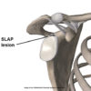 Research Review: Conservative Treatment of a SLAP lesion SLAP