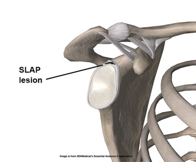 Research Review: Conservative Treatment of a SLAP lesion - Academy of ...