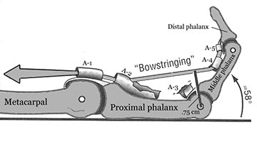 Flexor pulley injury