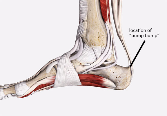 Location of Haglund's deformity or "pump bump"