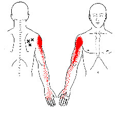 common trigger points in infraspinatus