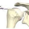 Figure 2: Greater tuberosity of humerus where pain is often felt