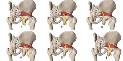 Six variations of sciatic nerve pathway in relation to the piriformis
