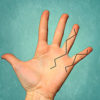 Dupuytren’s Contracture Figure 3 Z-Plasty incision pattern