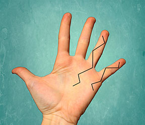 Figure 3 Z-Plasty incision pattern