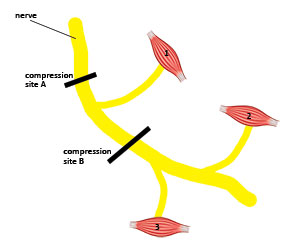 Location of symptoms in relation to nerve fiber innervation of muscles