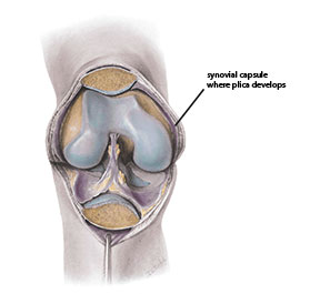 synovial plica