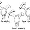 the three types of acromion process