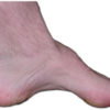 Figure 2
The pes cavus foot that is common in CMT disease
Image courtesy of Wikipedia
