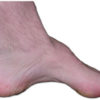 Exploring Charcot Marie Tooth Disease Figure 2
The pes cavus foot that is common in CMT disease
Image courtesy of Wikipedia
