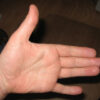 Guyon’s Canal Syndrome Image 5
Atrophy of hand muscles (flatness of palm) from ulnar nerve compression
Image courtesy of Wikimedia Commons
