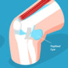 What is a Baker’s Cyst? Image of a Baker's Cyst