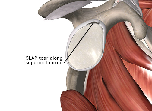 Image of SLAP lesion of the labrum