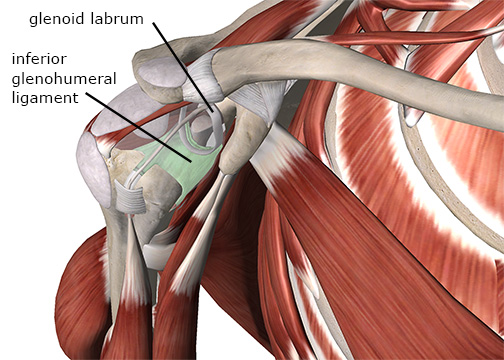 Bankart lesion on the inferior region of the glenoid labrum
