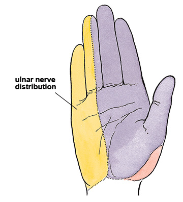 Image showing the area of the hand innervated by the ulnar nerve
